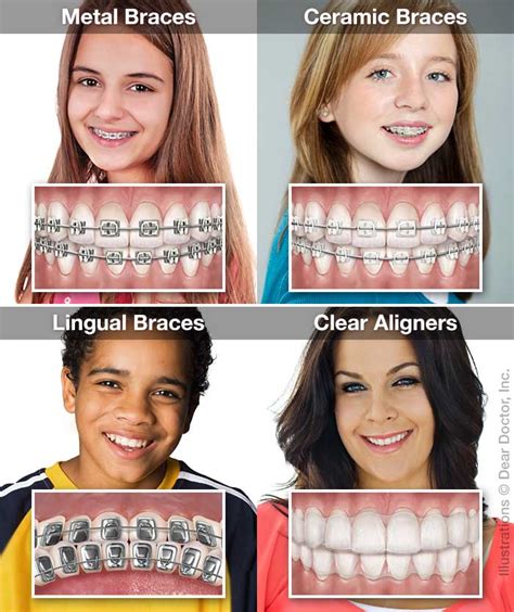 Magical orthodontic appliance for an instant smile upgrade